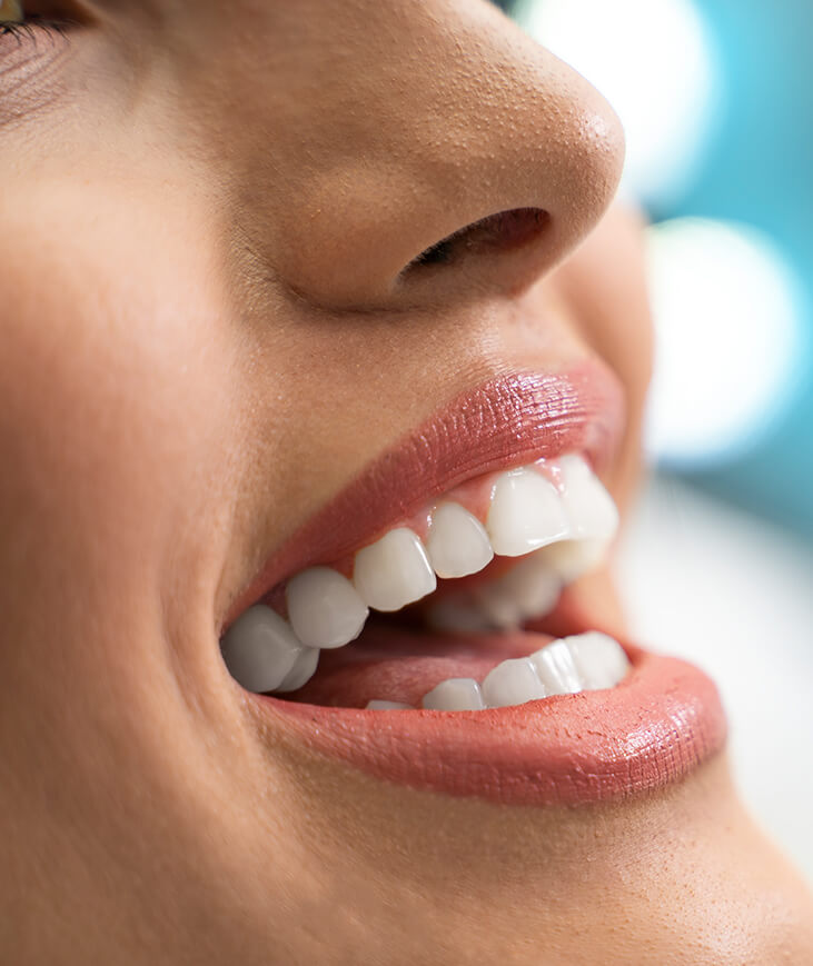 What are white fillings?