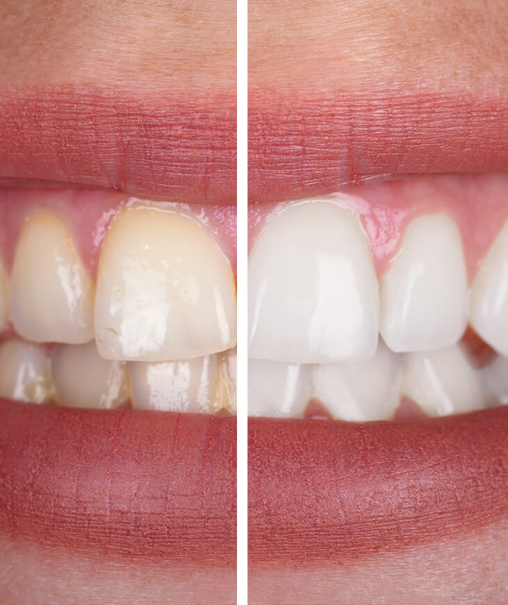 Why choose professional teeth whitening?