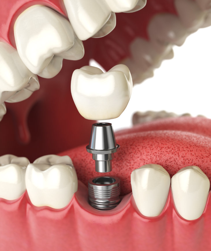 Dental implants – The gold standard in tooth replacement