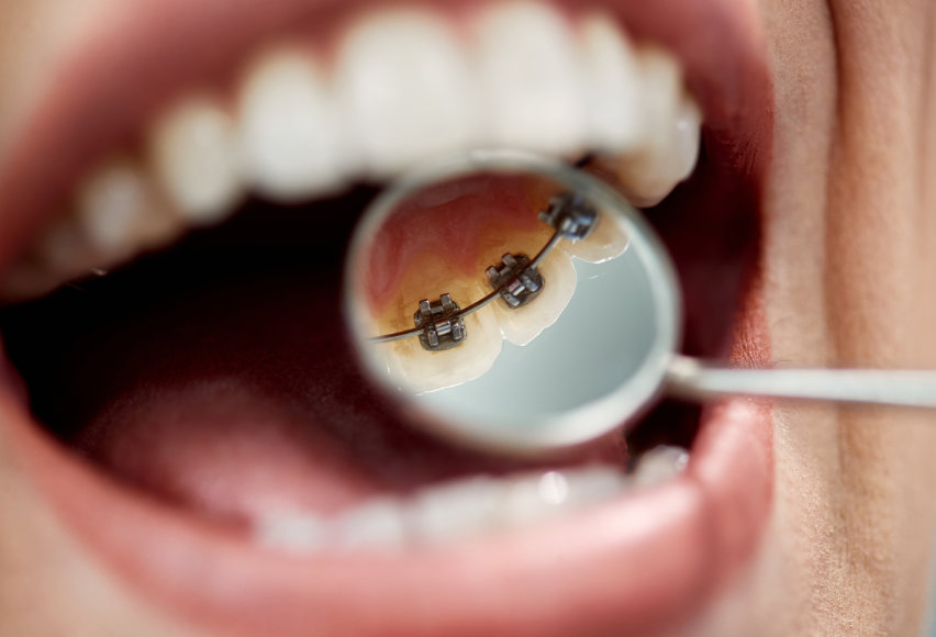 Incognito® hidden braces 