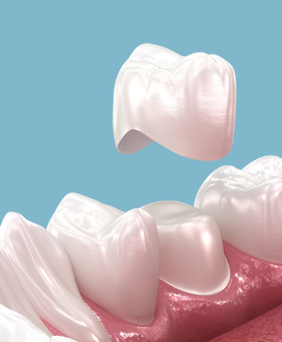 Restore the integrity of damaged or weakened teeth with same-day dental crowns. 