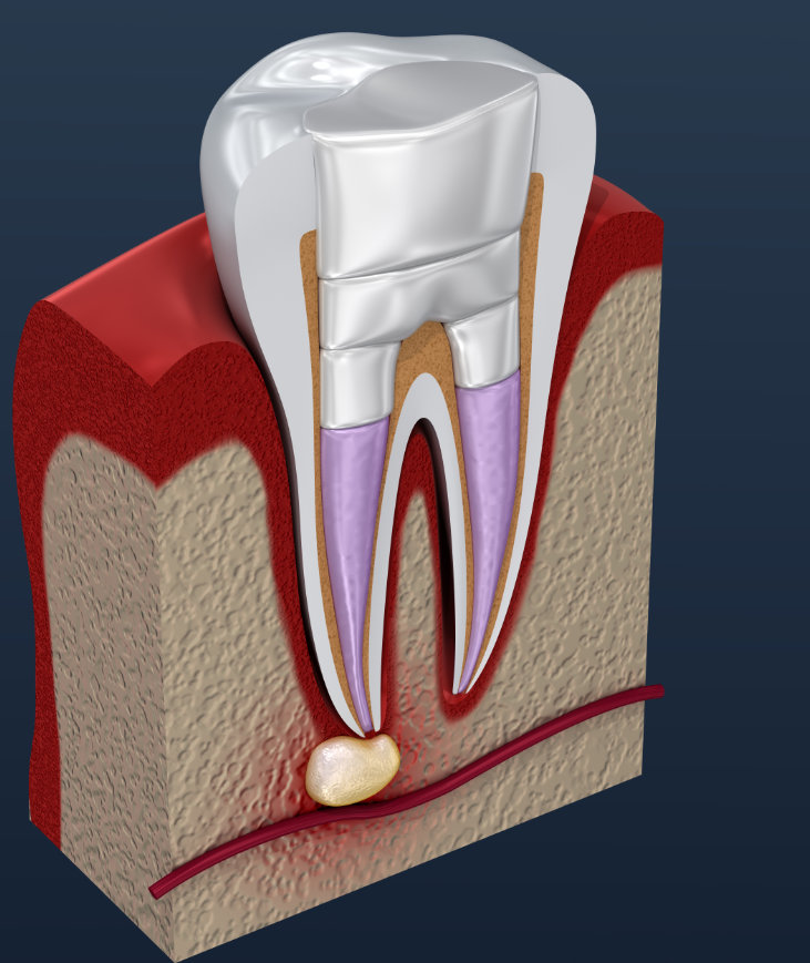 What is root canal therapy?