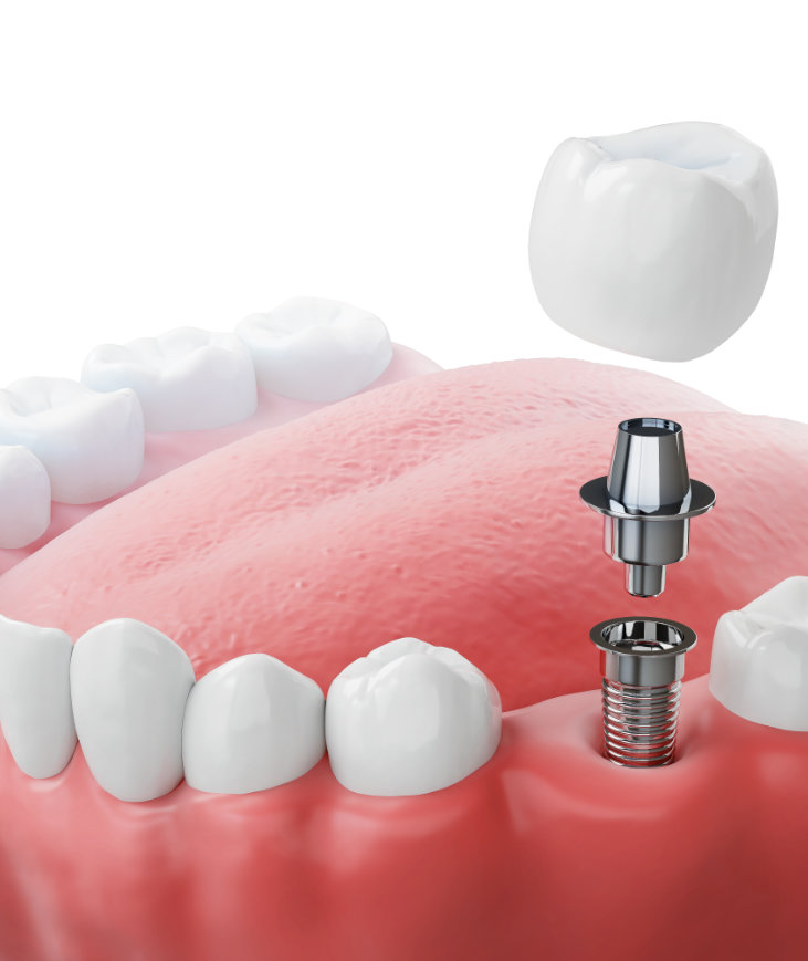 What is a single tooth dental implant?