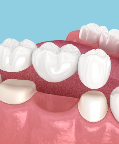 Replace missing teeth with custom dental bridges. 