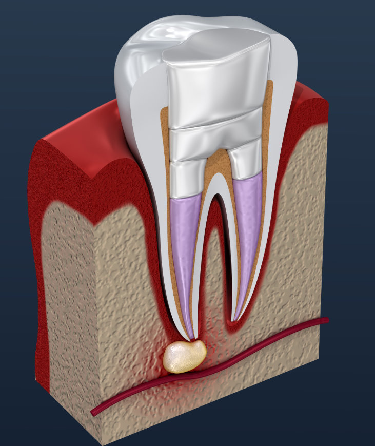 Root canal treatment 