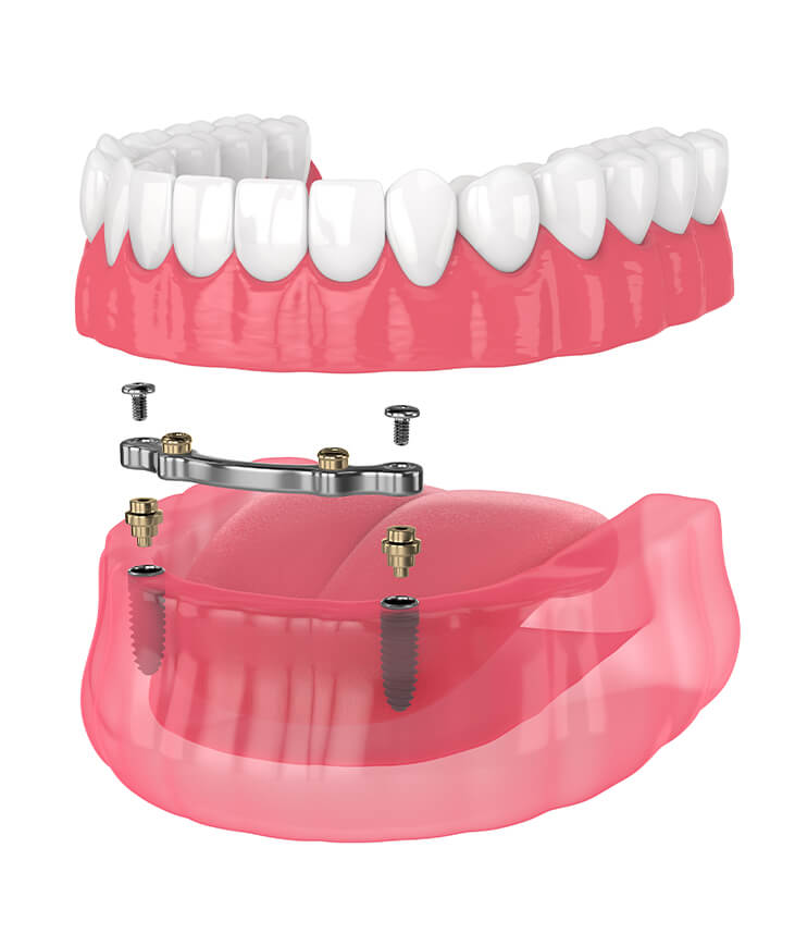 What are implant retained dentures?