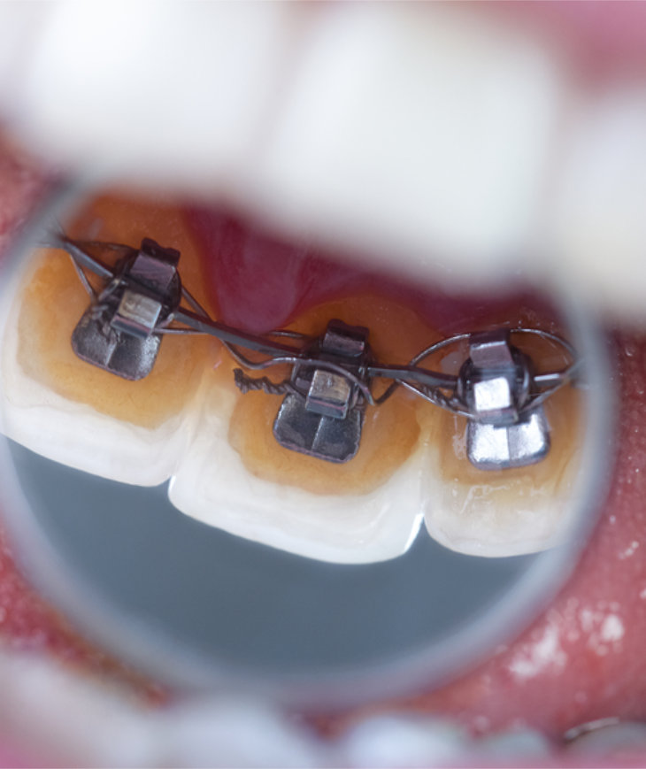 What are Incognito hidden braces?