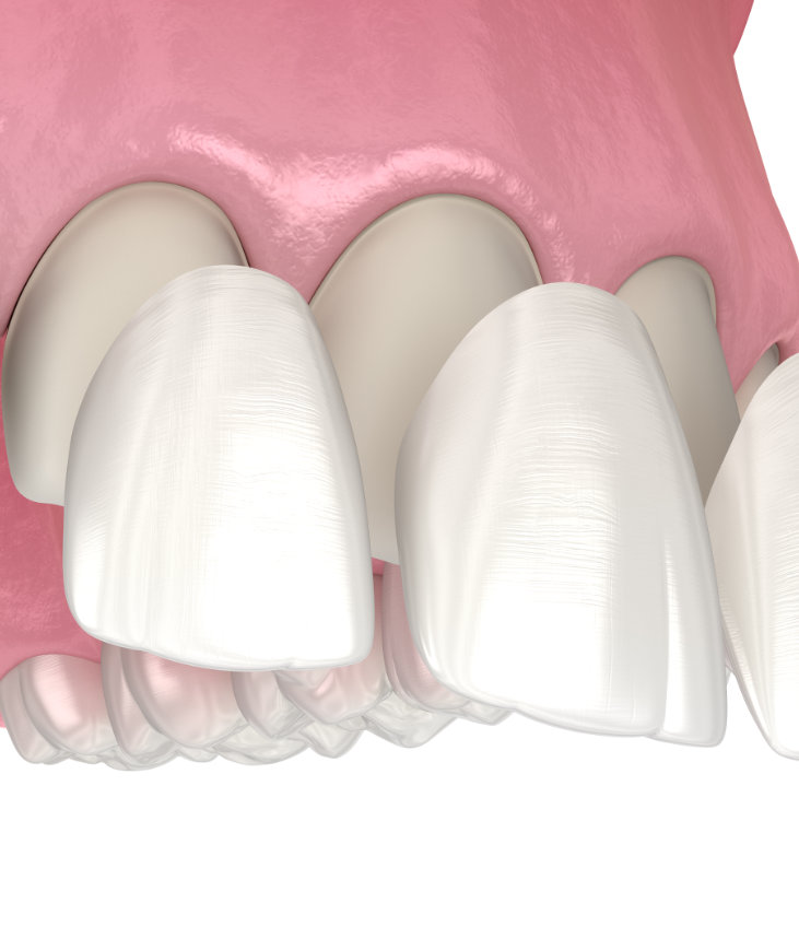 What is composite bonding?