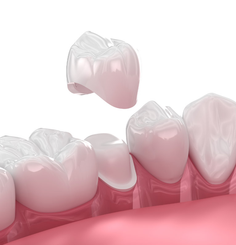 State-of-the-art CEREC crowns at Stoke Bishop