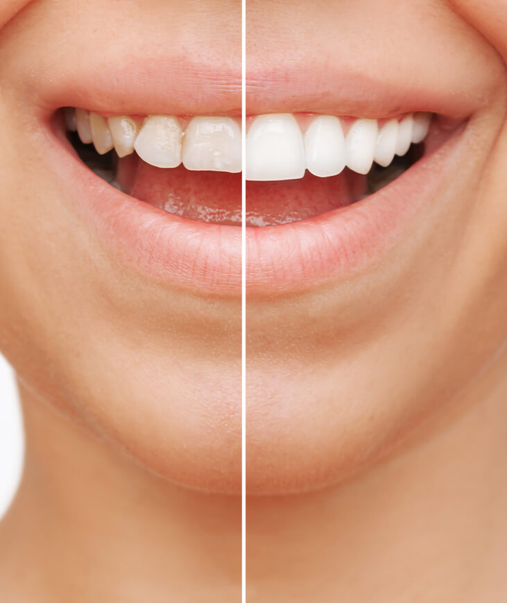 What are veneers?