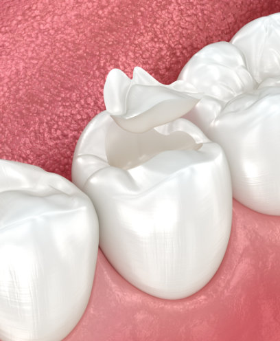 Inlays and onlays provide a middle ground between fillings and dental crowns.