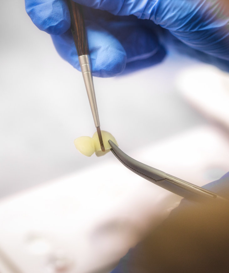 Benefits of inlays and onlays