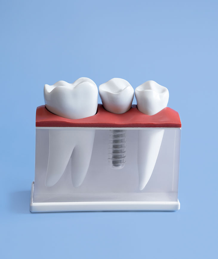 What are dental implants? 