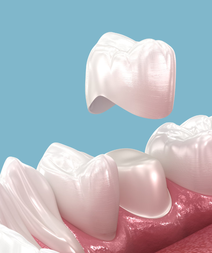 Why might you need a crown?