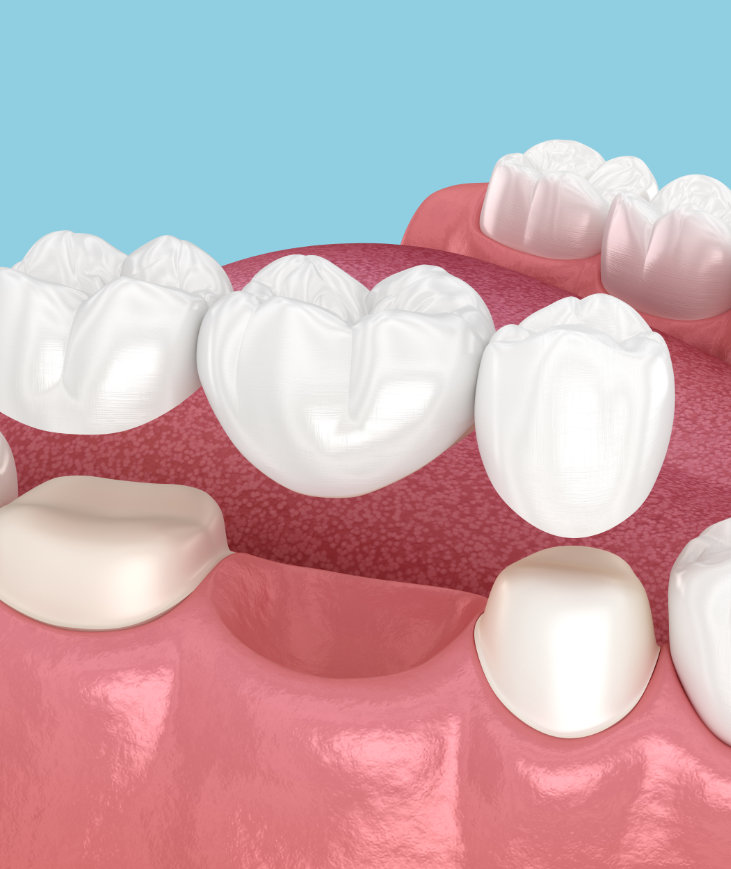 What is a dental bridge?