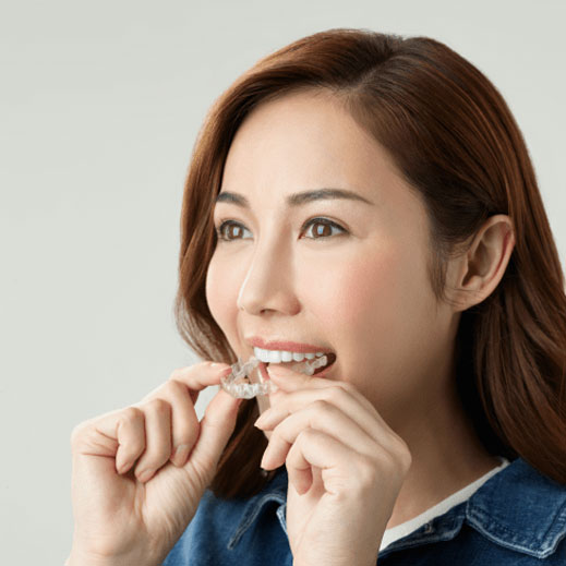 INVISALIGN FOR ADULTS