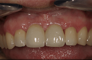 After - Stoke Bishop Dental Centre